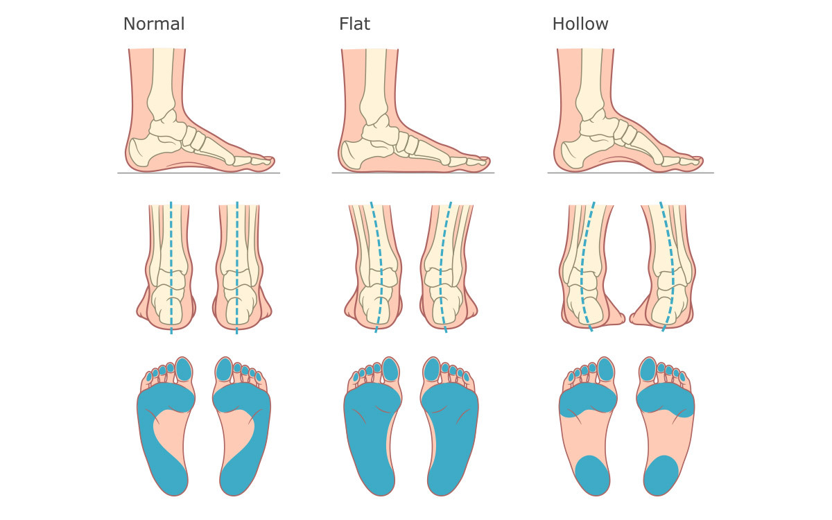 Different foot arches
